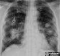 Cavitary Metastases